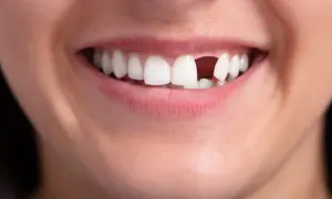 Jak uzupełnić brakujące zęby: najlepsze metody i ich zalety