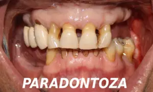 Zaawansowana paradontoza z widocznymi ubytkami kości i zębów. Rozważenie implantów jako rozwiązania problemu.
