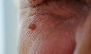Mały, brodawkowaty narośl na skórze, przypominający brodawczak HPV w jamie ustnej.