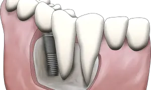 Ilustracja pokazuje, jak uzupełnić brak tylnych zębów za pomocą implantu stomatologicznego. Implant jest wkręcony w kość szczęki, a na nim osadzona jest korona zęba.