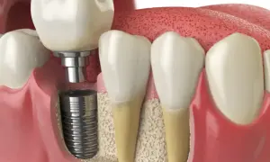 Białe dziąsło po wszczepieniu implantu. Widoczny implant stomatologiczny z koroną, osadzony w kości szczęki.
