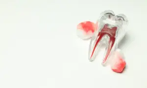 Przezroczysty model zęba z czerwonymi korzeniami, otoczony wacikami z krwią, symbolizuje prawidłowy skrzep po ekstrakcji.