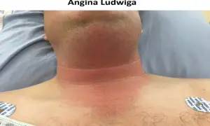 Objawy ropowicy dna jamy ustnej – jak je rozpoznać i unikać powikłań