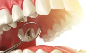 Zepsuty ząb widziany w lusterku dentystycznym. Dowiedz się, ile kosztuje plomba światłoutwardzalna, by przywrócić uśmiech.