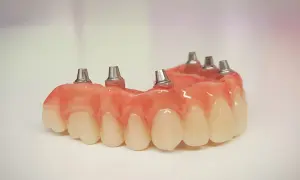 Proteza częściowa na NFZ z metalowymi elementami mocującymi, gotowa do implantacji.