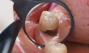 Widok z lusterka dentystycznego: resztka zęba w dziąśle, z widocznym ciemnym wypełnieniem i fragmentem korony.