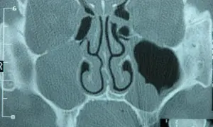 Tomografia zatok. Widoczna torbiel zatoki szczękowej po prawej stronie. W dolnym rogu mały obrazek z profilu głowy, sugerujący dalszą diagnostykę, być może w kierunku raka.