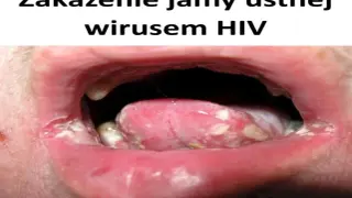Zakażenie jamy ustnej wirusem HIV objawia się m.in. nalotem na języku i pleśniawkami.