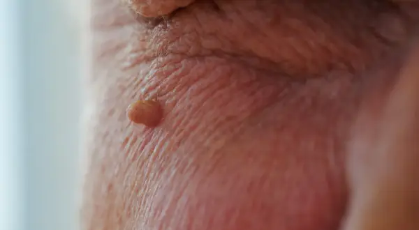Mały, brodawkowaty narośl na skórze, przypominający brodawczak HPV w jamie ustnej.