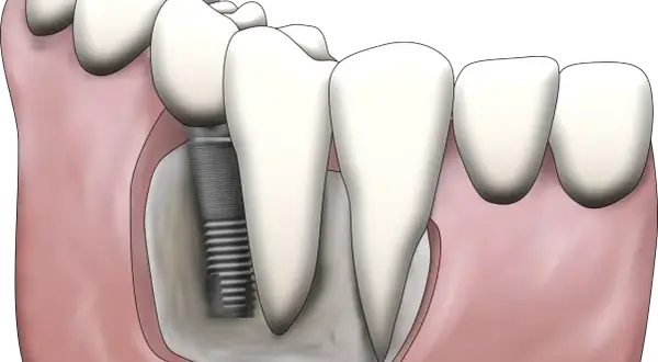 Ilustracja pokazuje, jak uzupełnić brak tylnych zębów za pomocą implantu stomatologicznego. Implant jest wkręcony w kość szczęki, a na nim osadzona jest korona zęba.