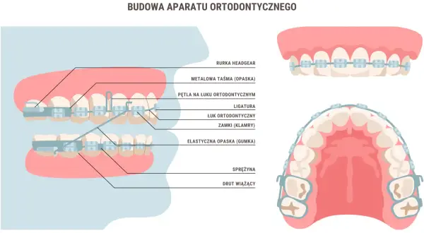 Schemat aparatu ortodontycznego z widocznymi elementami, takimi jak zamki, łuk, ligatury i sprężynki.