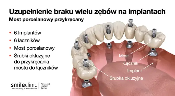 Ilustracja pokazuje, jak uzupełnić brak jednego zęba za pomocą mostu porcelanowego przykręcanego na 6 implantach. Widoczne są implanty, łączniki i śrubki.