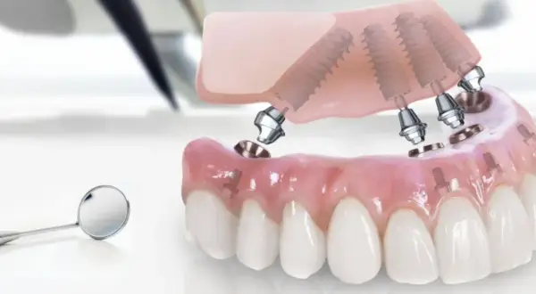 Model szczęki z implantami, gotowy do montażu. Rozważ implanty w Turcji dla pięknego uśmiechu.