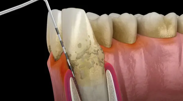 Narzędzie dentystyczne bada głęboką dziurę w zębie, odsłaniając kamień nazębny i stan zapalny dziąseł.