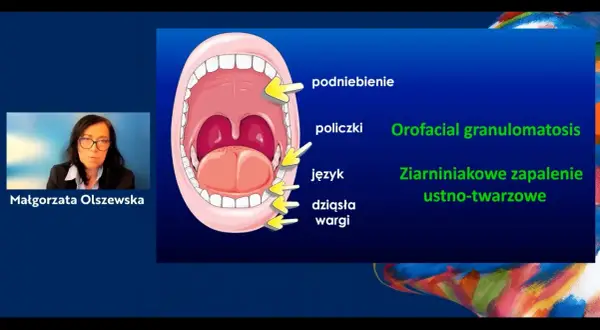 Ilustracja jamy ustnej z zaznaczonymi podniebieniem, policzkami, językiem i dziąsłami. Obok tekst: Orofacial granulomatosis, Ziarniniakowe zapalenie ustno-twarzowe.