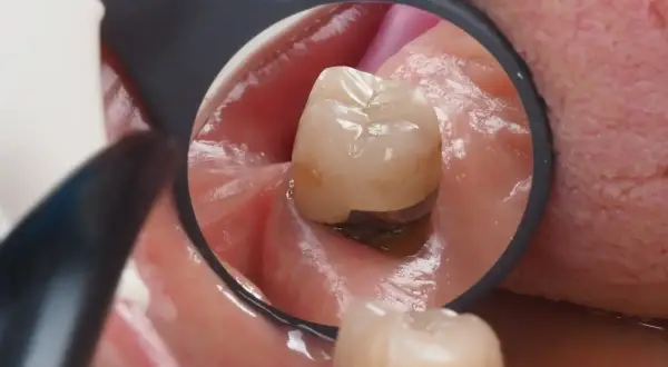 Widok z lusterka dentystycznego: stan zapalny dziąsła pod koroną zęba, zaczerwienienie i obrzęk.