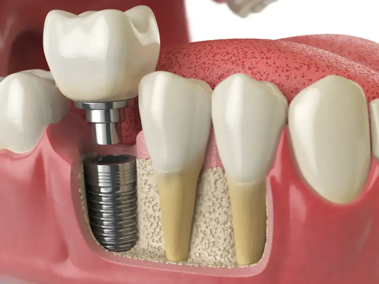 Białe dziąsło po wszczepieniu implantu. Widoczny implant stomatologiczny z koroną, osadzony w kości szczęki.