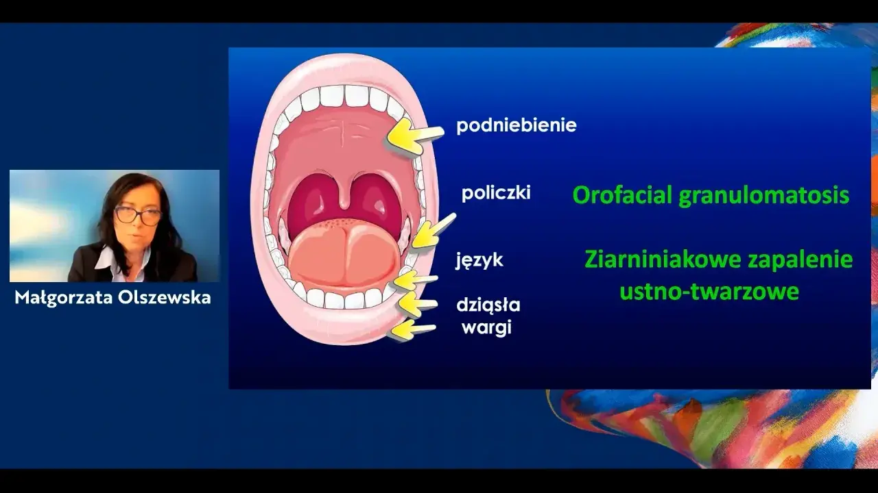 Ilustracja jamy ustnej z zaznaczonymi podniebieniem, policzkami, językiem i dziąsłami. Obok tekst: Orofacial granulomatosis, Ziarniniakowe zapalenie ustno-twarzowe.