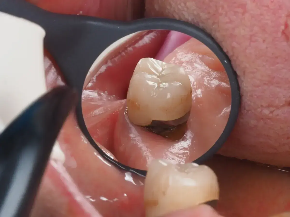 Widok z lusterka dentystycznego: stan zapalny dziąsła pod koroną zęba, zaczerwienienie i obrzęk.