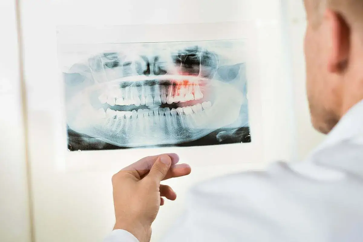 Dentysta analizuje zdjęcie RTG szczęki, gdzie czerwony obszar wskazuje na torbiel.