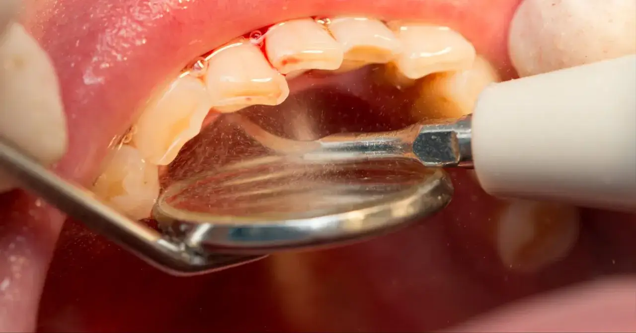 Zabieg skaling i piaskowanie NFZ. Dentysta usuwa kamień i osad z zębów pacjenta za pomocą specjalistycznego sprzętu.