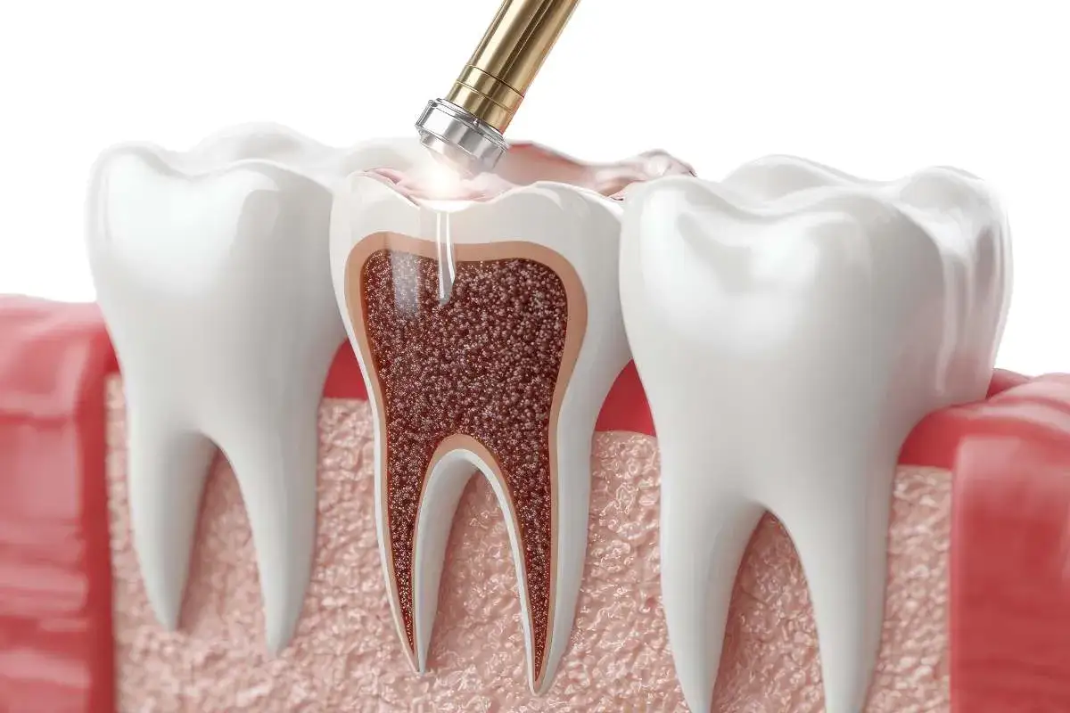 Ząb leczony kanałowo boli, gdy narzędzie dentystyczne wchodzi w jego wnętrze.