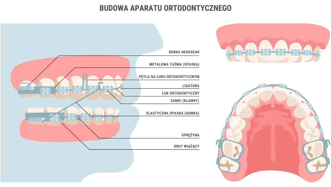 Budowa aparatu ortodontycznego, który może być dostępny jako aparat ortodontyczny na NFZ dla dorosłych. Ilustracja pokazuje elementy aparatu na zębach.