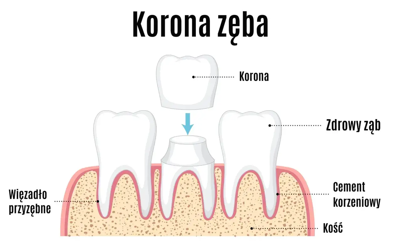 Ilustracja pokazuje proces zakładania korony zęba. Widoczne są zdrowe zęby, cement korzeniowy, kość i więzadło przyzębne. Korona zęba NFZ jest kluczowym elementem odbudowy.