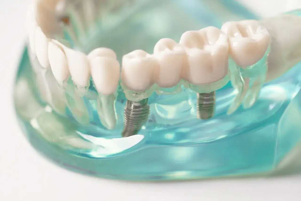 Model szczęki z implantami. Widoczna kość, w której osadzone są zęby, wsparte na implantach.