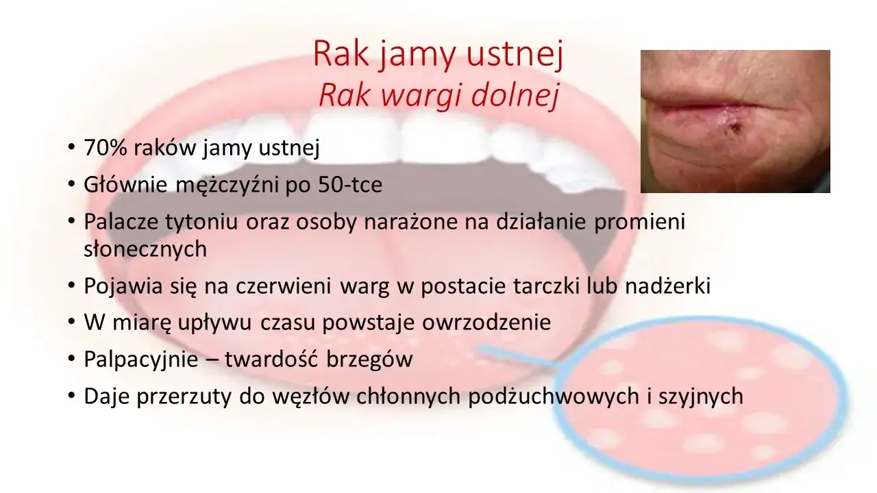 Zdjęcie Nowotwór jamy ustnej objawy: jak je rozpoznać i uniknąć zagrożenia