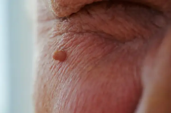 Mały, brodawkowaty narośl na skórze, przypominający brodawczak HPV w jamie ustnej.