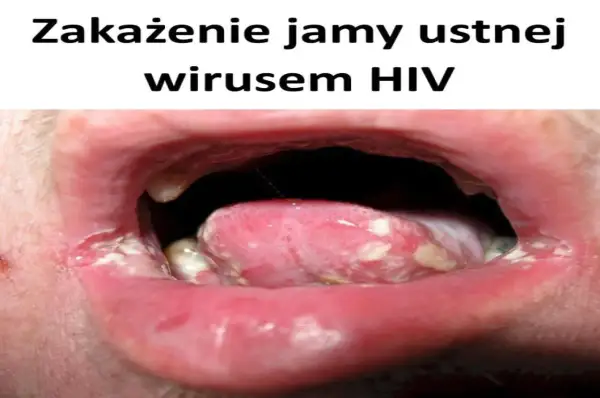 Zakażenie jamy ustnej wirusem HIV objawia się m.in. nalotem na języku i pleśniawkami.